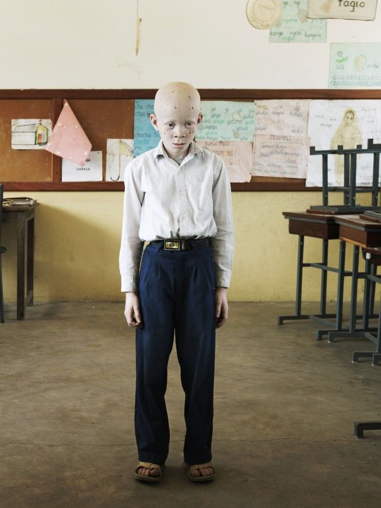 enfants albinos