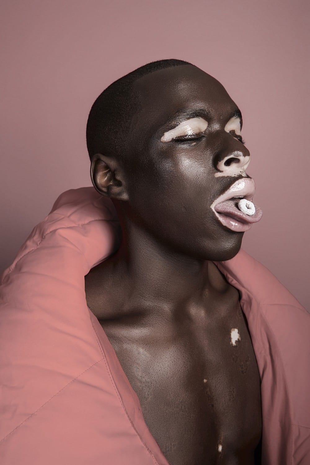  le vitiligo photographie