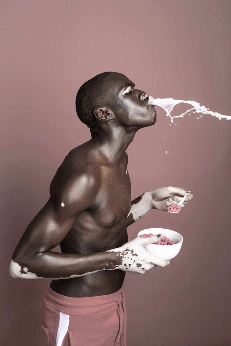  le vitiligo en photographie