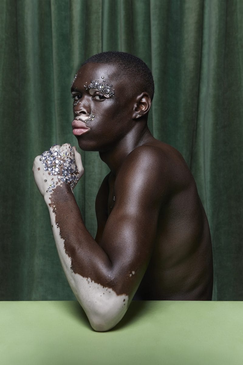 photographie sur le vitiligo 