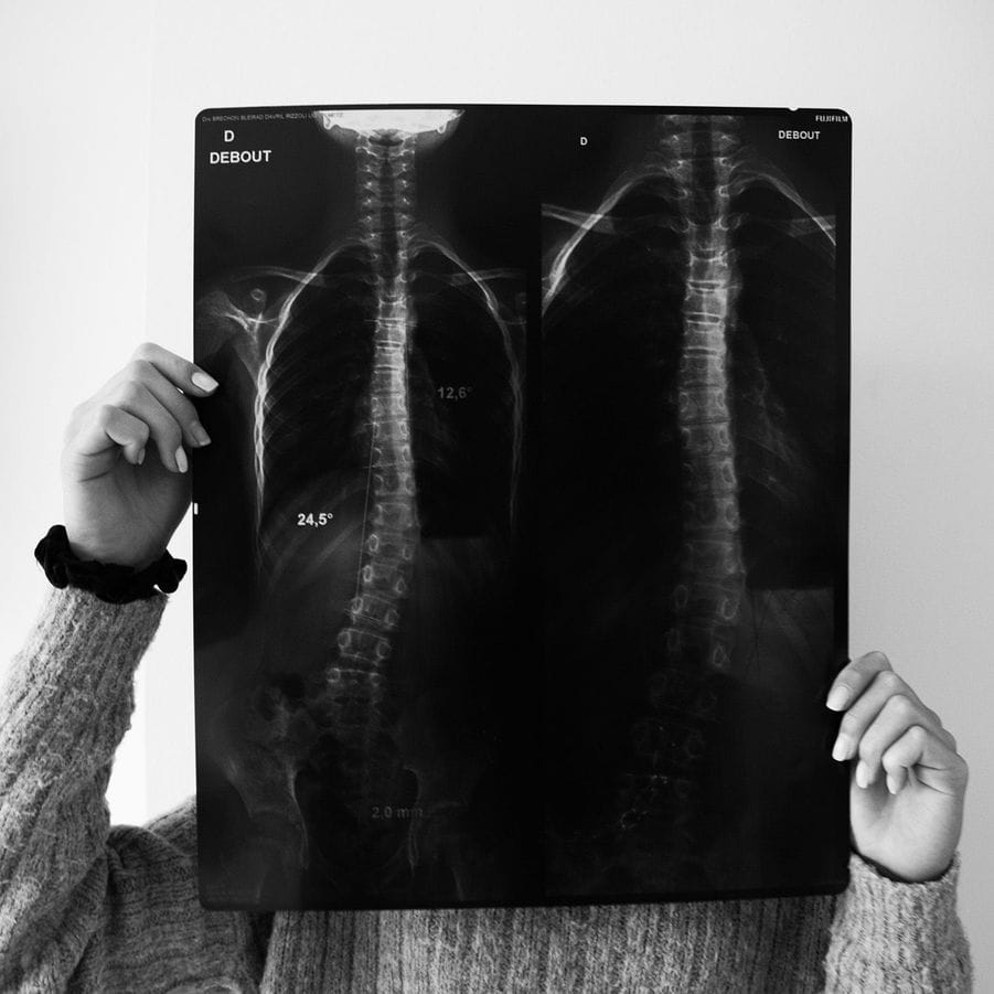 Photographie en noir et blanc, la jeune fille tient devant son visage les analyses de sa colonne vertébrale au rayon x