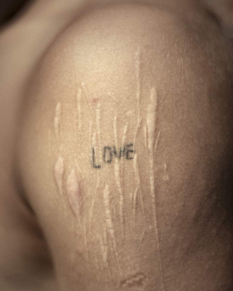 photographie ou le tatouage "love" est caché par des cicatrices 