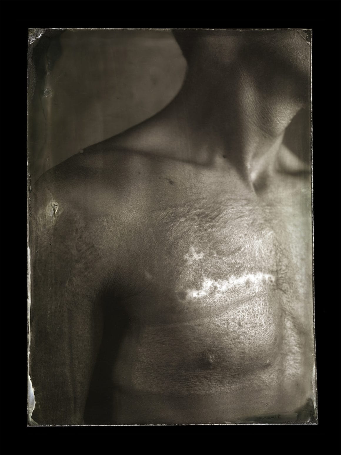 Photographie du torse d'un homme grand brûlé prise par Clément Marion